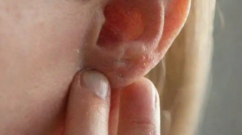 Close-up of pierced ear with medical tools