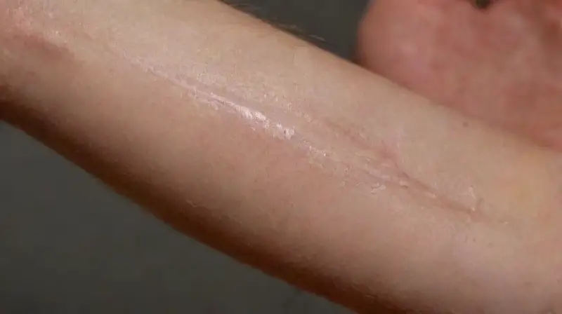 Close-up of tattoo treatment in clinical detail