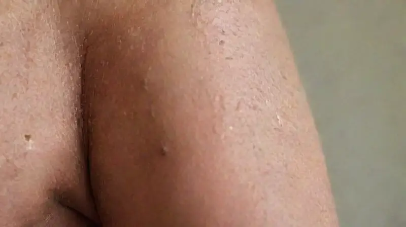 Close-up of skin, cream, syringe, in clinical setting