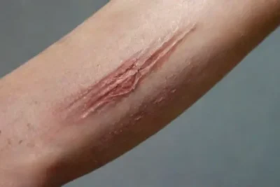 Common Side Effects of Tattoo Removal Treatments