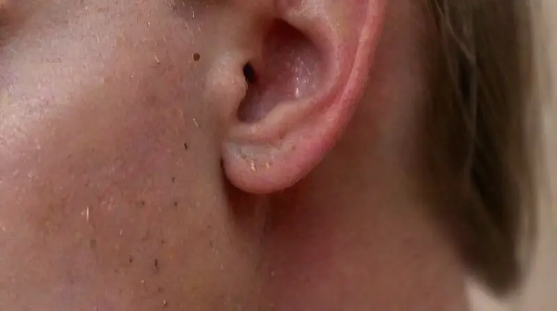 Close-up of pierced ear with healing details