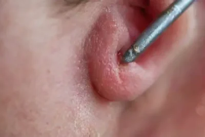 Risks of excessive bleeding during piercings